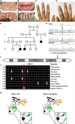 Case Report: A Missense Mutation in Dyskeratosis Congenita 1 Leads to a Benign Form of Dyskeratosis Congenita Syndrome With the Mucocutaneous Triad